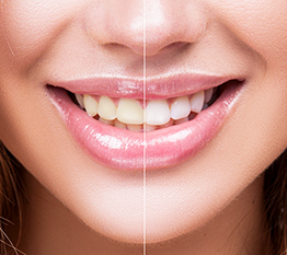 Dental Whitening - HPA Saúde