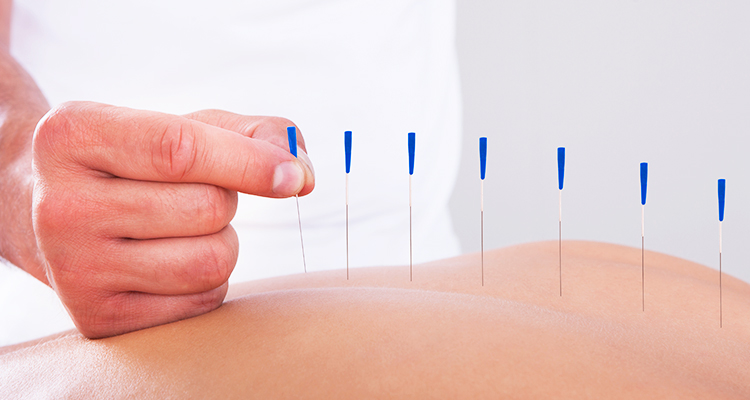 Acupuncture